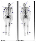 undersoegelser-scintigrafi3.jpg